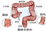 大腸類癌