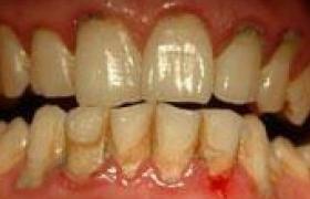 單純性牙周炎