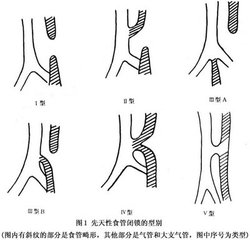 先天性食管閉鎖