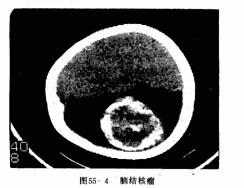 腦結核瘤