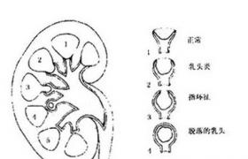 間質性腎炎