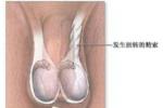 睪丸囊腫