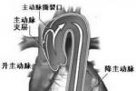 主動脈夾層