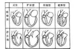 小兒肥厚型心肌病