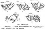 先天性腸閉鎖