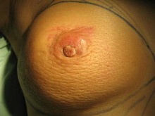 炎性乳腺癌