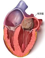 心臟黏液瘤