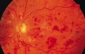 糖尿病性視網膜病變