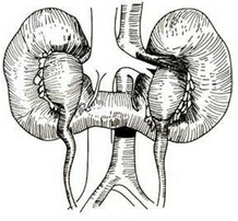 馬蹄形腎
