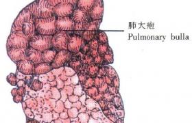 新生兒肺氣漏