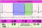小兒竇性心律失常