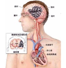 腦動脈硬化