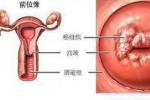 宮頸癌前病變