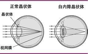 先天性白內障