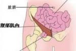 腹股溝疝