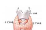 亞急性甲狀腺炎