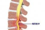 腰椎椎管狹窄癥