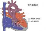 右室雙出口