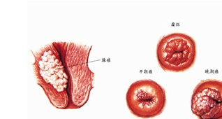 宮頸癌