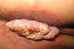 肛門直腸周圍膿腫