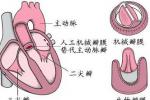 風濕性二尖瓣狹窄