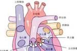 風濕性二尖瓣狹窄