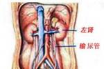 輸尿管結石