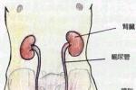 輸尿管結石
