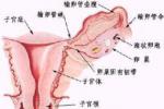 輸尿管結石