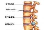 腰椎滑脫