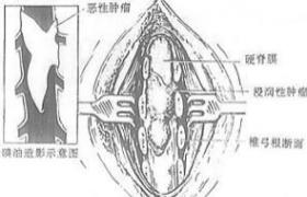 原發性椎管內腫瘤