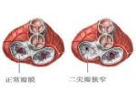 三尖瓣狹窄