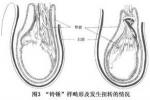 小兒睪丸扭轉