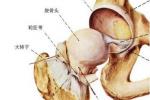 外傷性股骨頭壞死