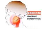 流行性腮腺炎