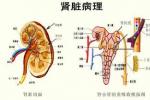 小兒遺傳性慢性進行性腎炎