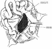 炎癥性腹主動脈瘤