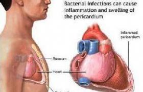 肺-胸膜阿米巴病