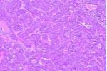 基底細胞腺瘤