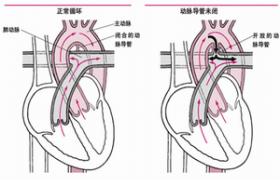 先天性冠狀動脈瘺