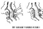 先天性冠狀動脈瘺