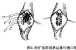 先天性冠狀動脈瘺