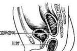 直腸重復畸形