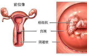 宮頸炎