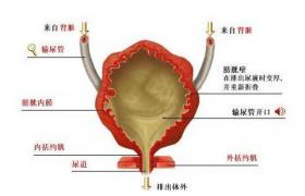 膀胱輸尿管反流