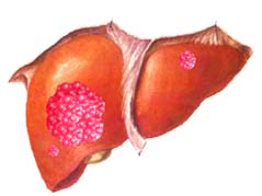 肝海綿狀血管瘤
