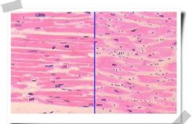 心肌致密化不全