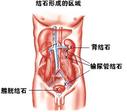 輸尿管腫瘤