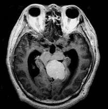 枕骨大孔腦膜瘤