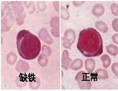 缺鐵性貧血